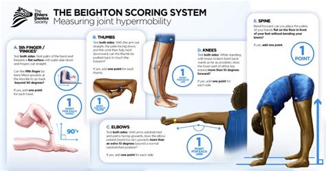 The Beighton Scoring System 